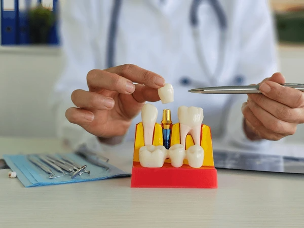 dental crowns in airdrie