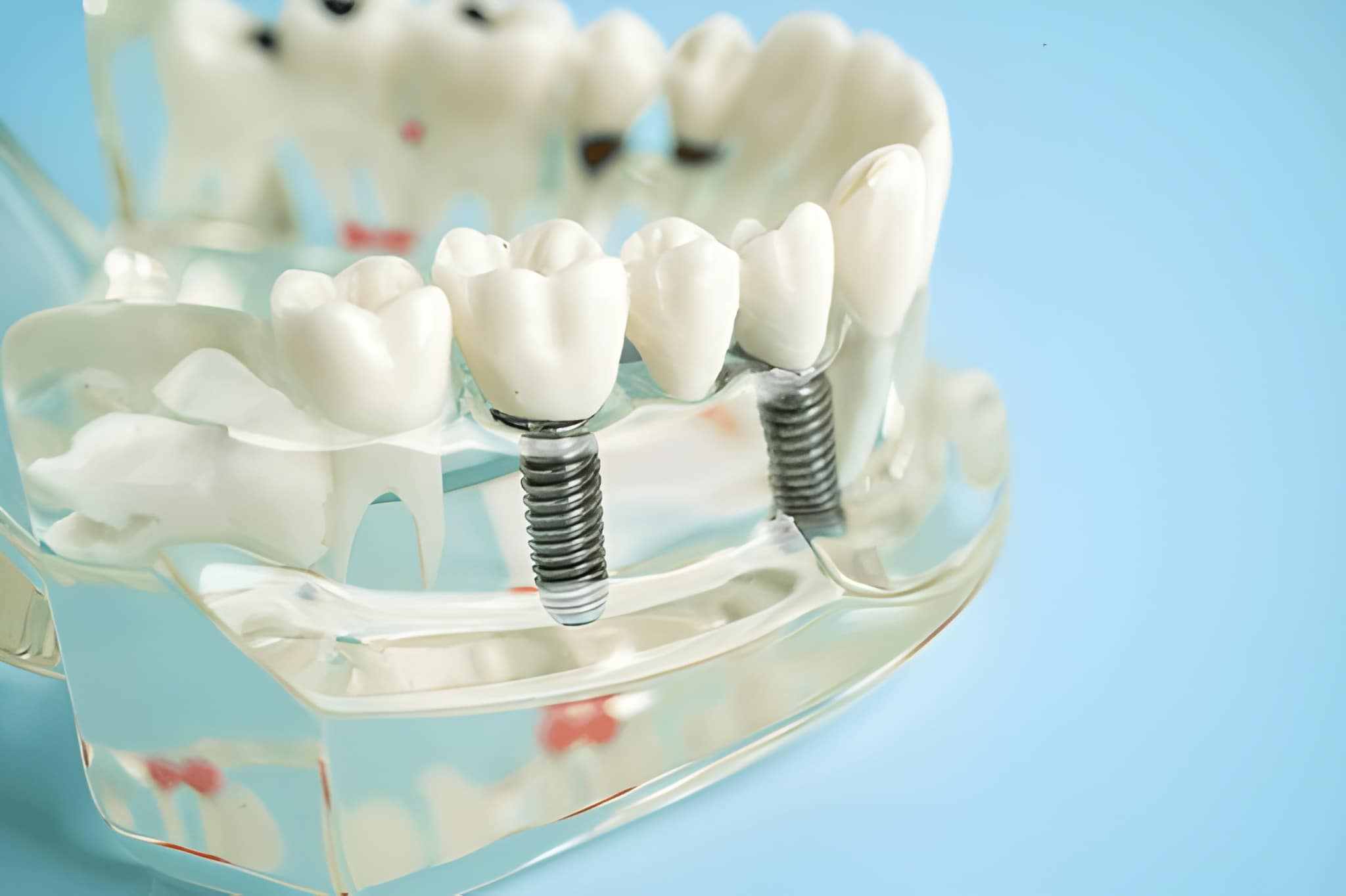 dental implants in airdrie