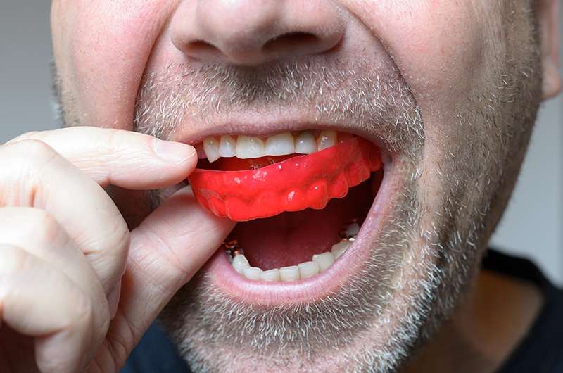 mouth guards in airdrie