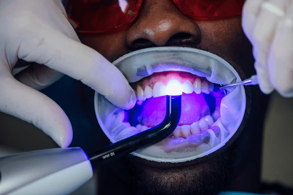 teeth whitemimg in airdrie