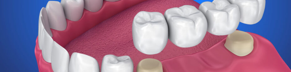 can dental bridges be replaced or removed
