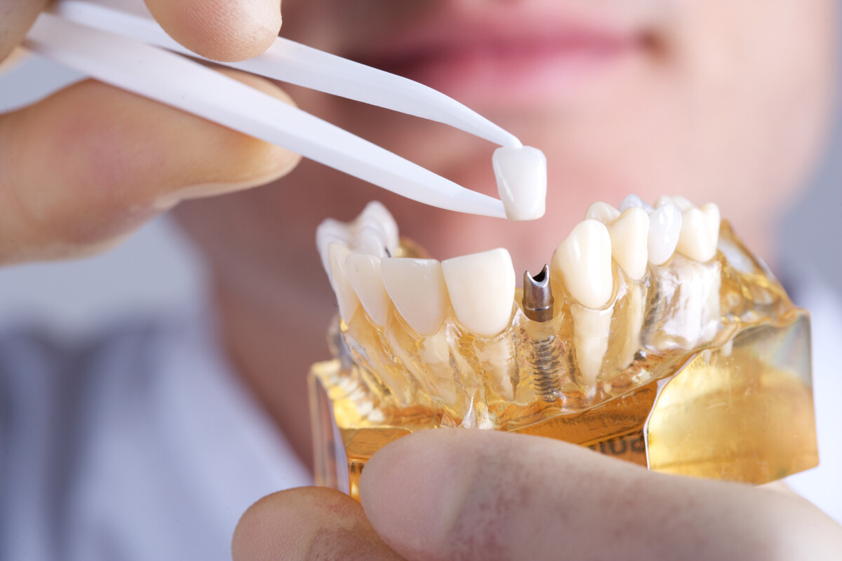 the fascinating history of dental implants beyond titanium