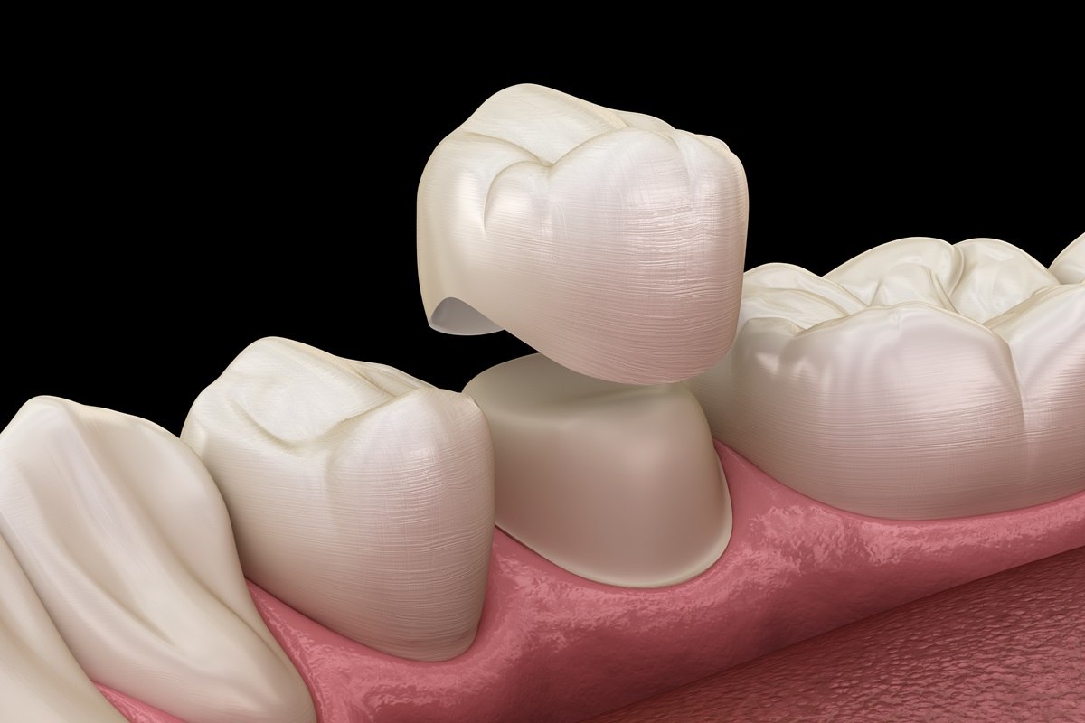 the dental crown process what to expect