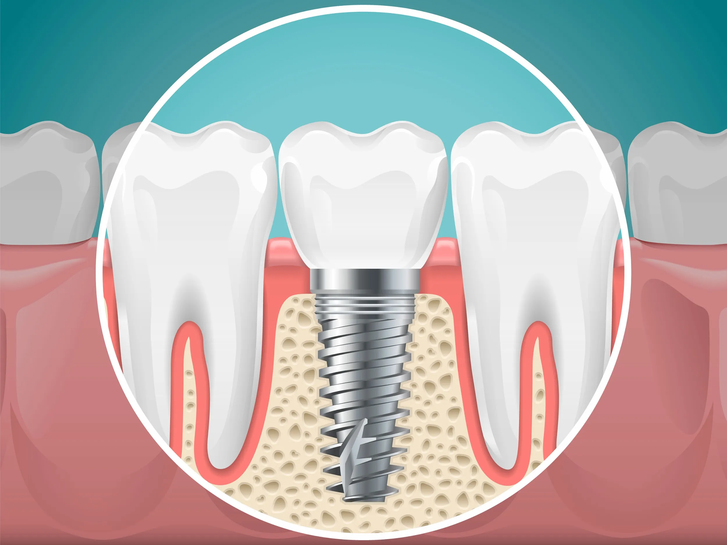 how do dental implants improve oral health
