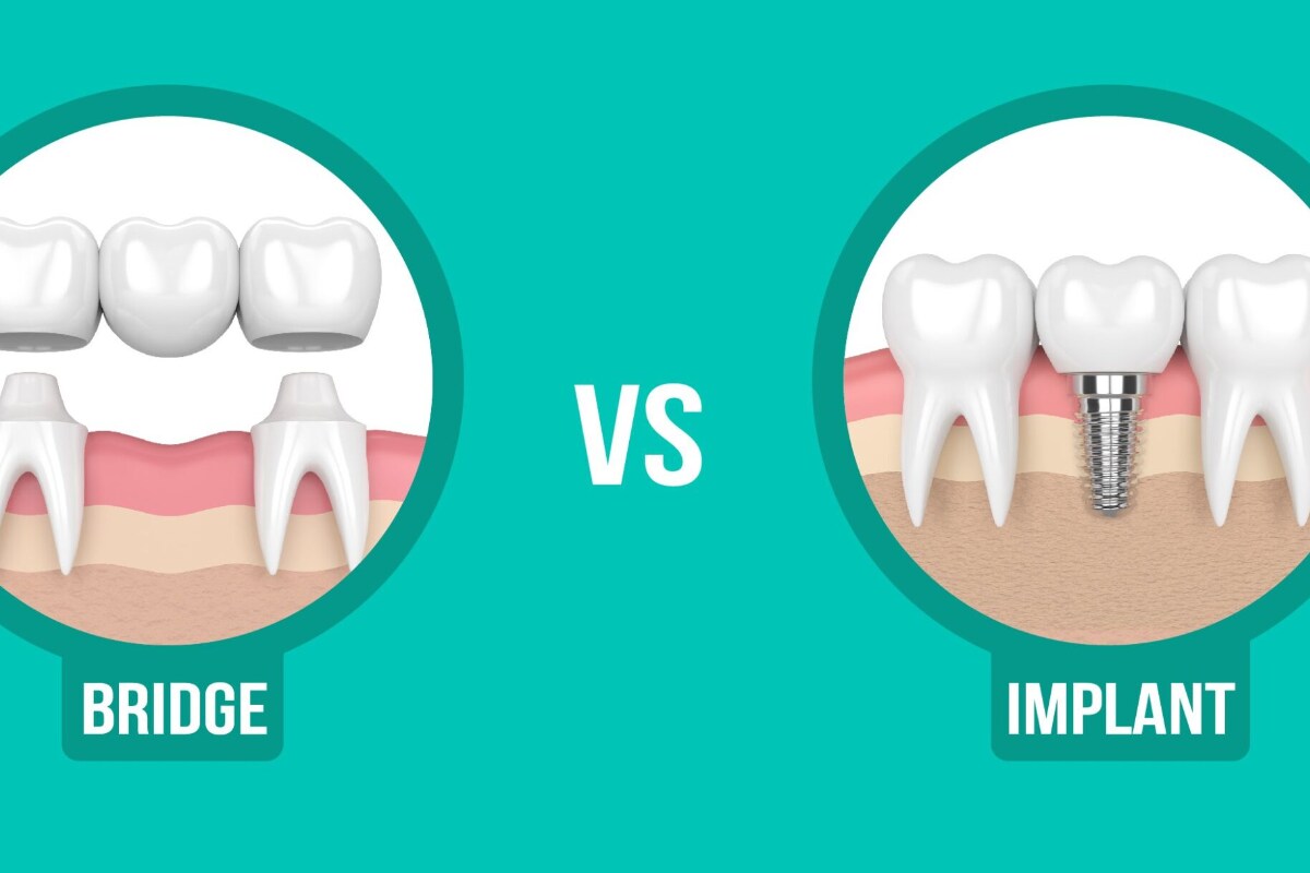 dental bridges vs dental implants which is right for you