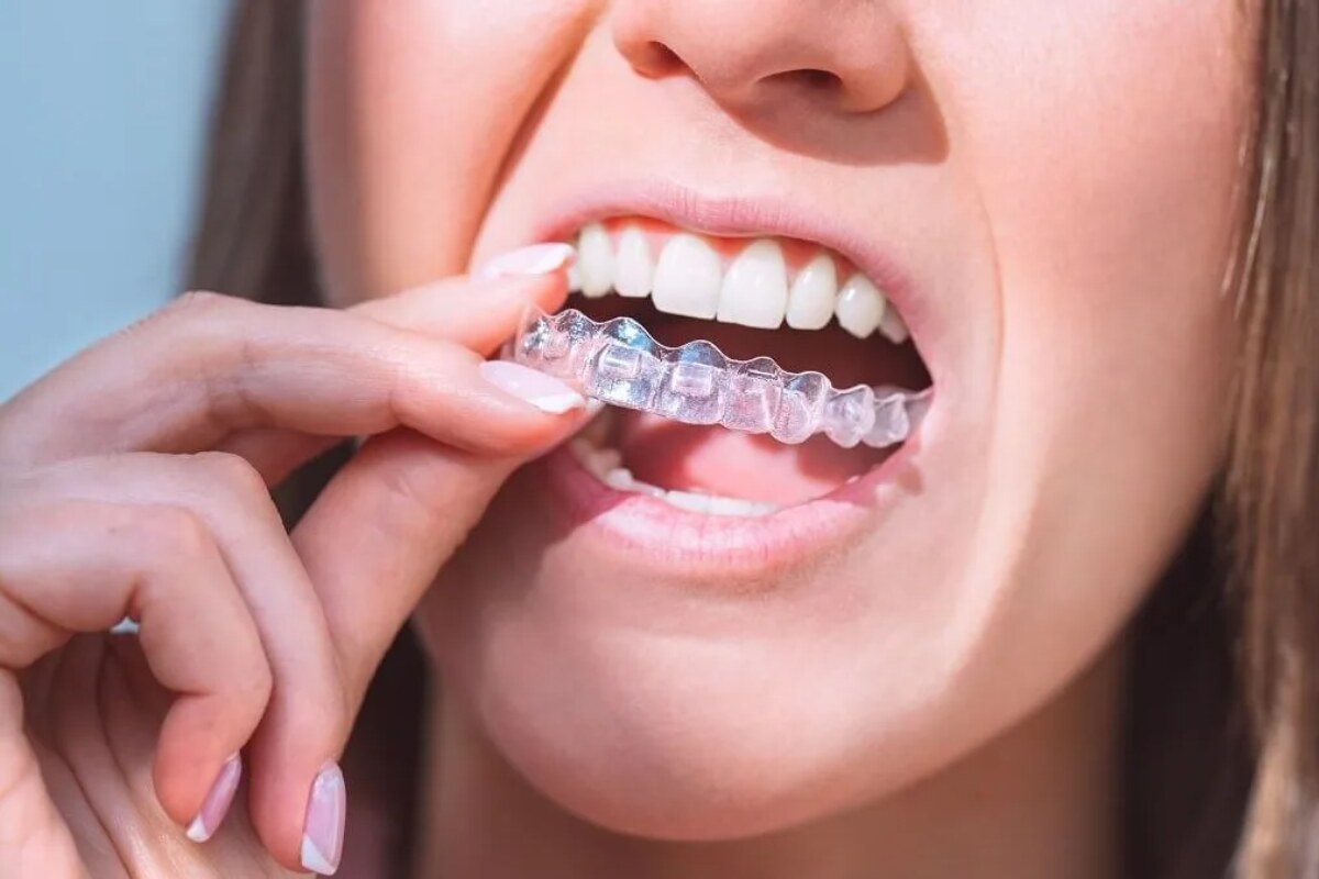 what is invisalign and how does it work