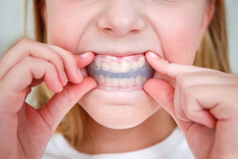 how a mouth guard can save your teeth from impact