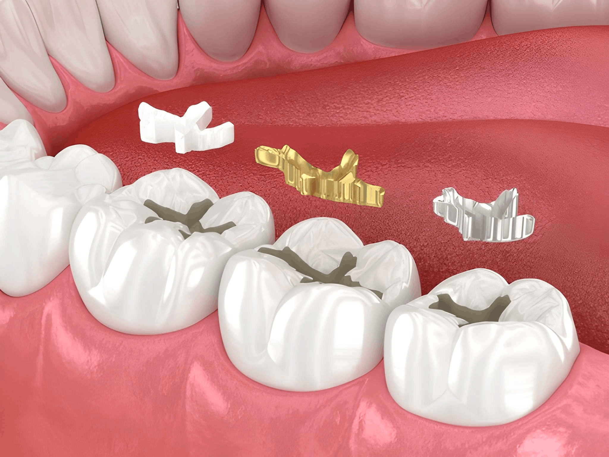 composite filling near you